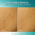 Dark Spot Exfoliant Peel2