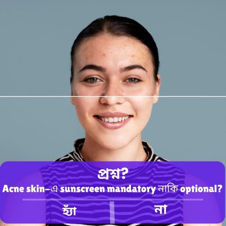 Best Sunscreen for Acne Prone Skin: ব্রণ-প্রবণ ত্বকের জন্য সেরা সানস্ক্রিন গাইড